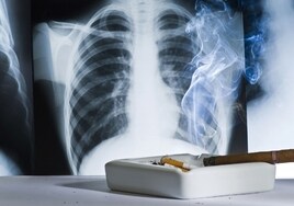 Spain rolls out national pilot screening programme for early detection of lung cancer