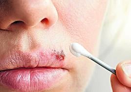 Why do we get cold sores and how can we treat them?