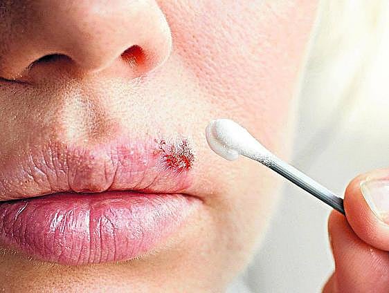 Why do we get cold sores and how can we treat them?