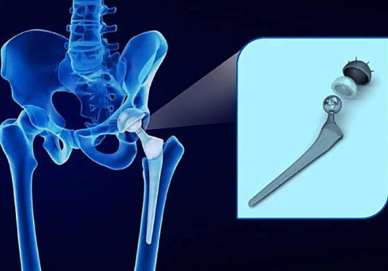 Spanish public prosecutor seeks 6.8 million euros compensation from British firm over 'faulty' hip replacements