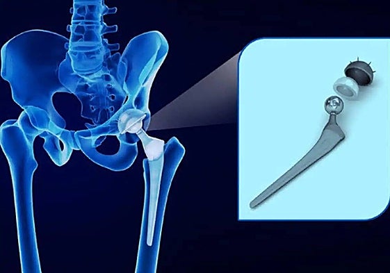 Example of the type of prothesis at the centre of the case.
