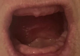 The state of her mouth after the operation.