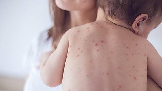Measles outbreak detected at a Costa del Sol nursery