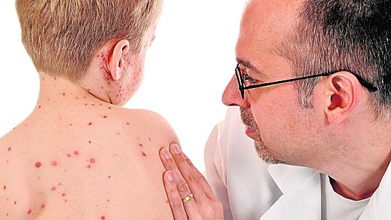 Second measles outbreak detected