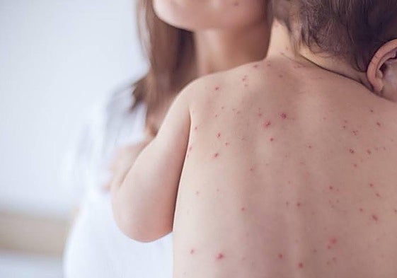 Cases of measles began to appear in Malaga just over a month ago.