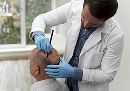 Debunking myths about hair transplants