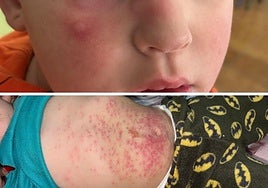 Children affected by plague of dangerous processionary caterpillars in town in southern Spain