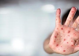 The regional health ministry will start providing weekly measles reports.