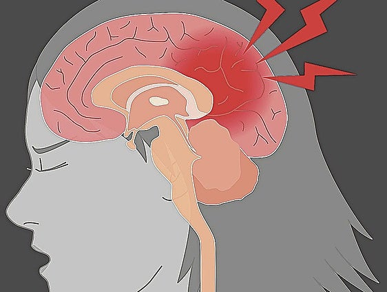 Men and women are different, even when it comes to strokes
