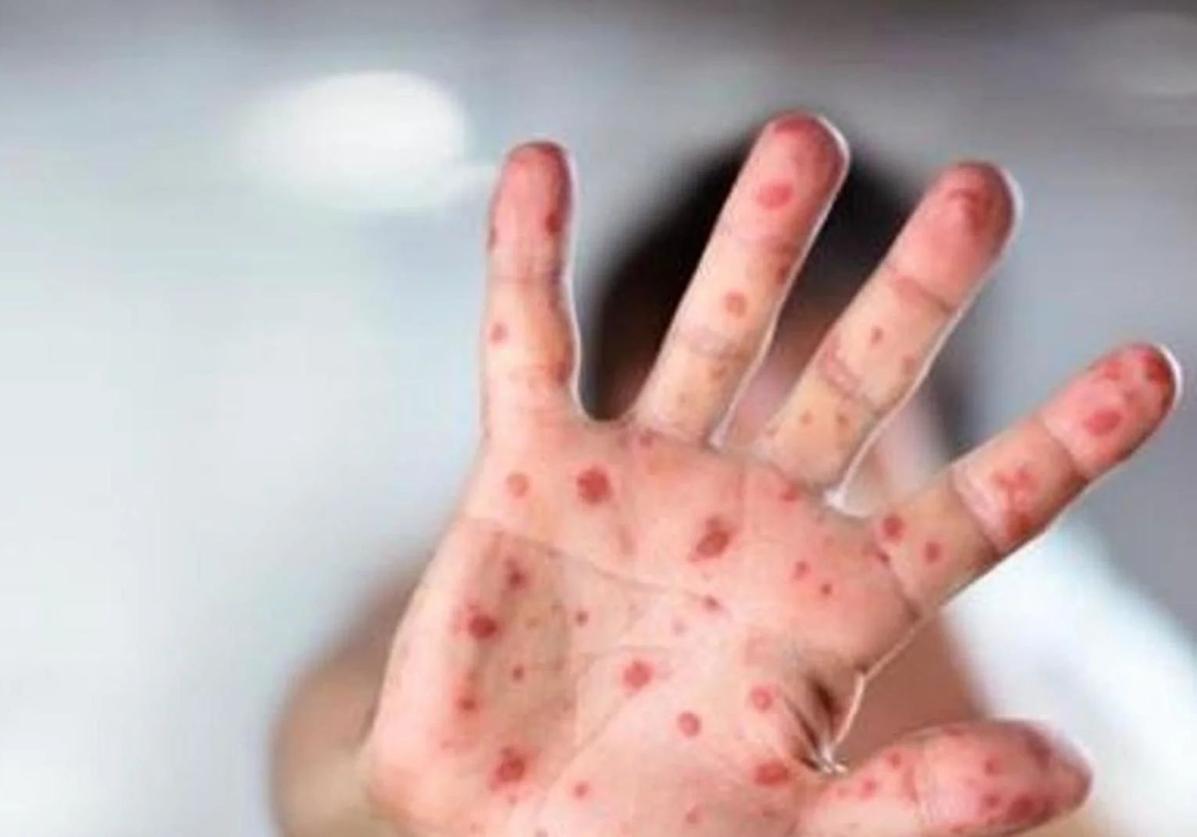 Junta does not rule out new outbreaks of measles in Andalucía