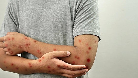 Malaga records 45 cases of measles and these are the three active outbreaks