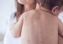 Andalucía still has six active outbreaks of measles in the region and this is precisely where they are