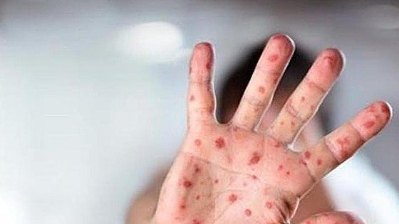 Two confirmed cases of Measles on eastern Costa del Sol brings Andalusian total to 88 this year