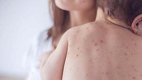 New case of measles confirmed in six-month-old child on eastern Costa del Sol