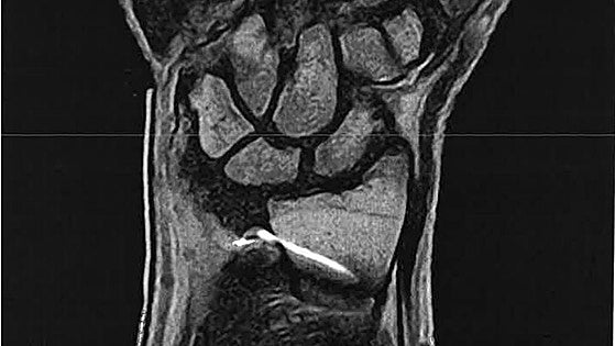 SAS ordered to compensate patient 67,000 euros after doctor left part of needle inside following operation in Malaga