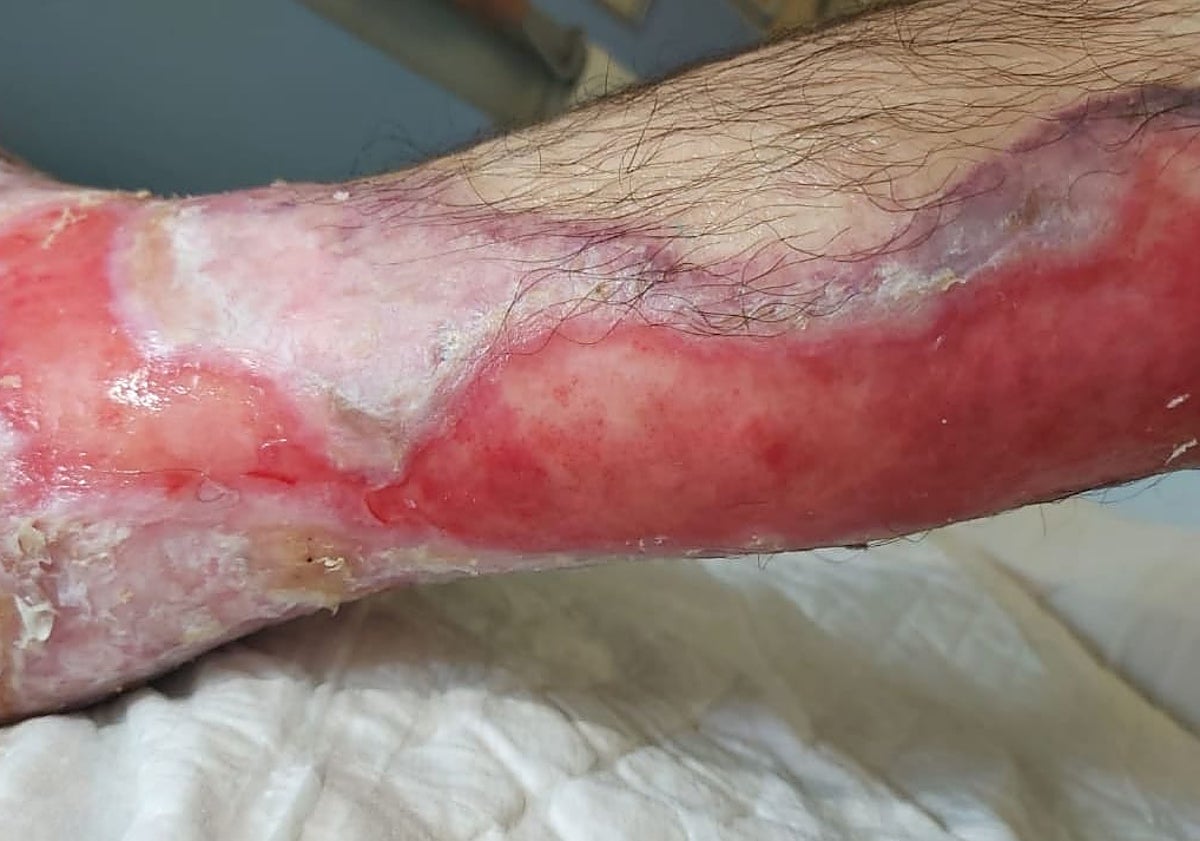 Imagen principal - Some of the more than 80 wounds that Adrián has over his body as a result of the disease.