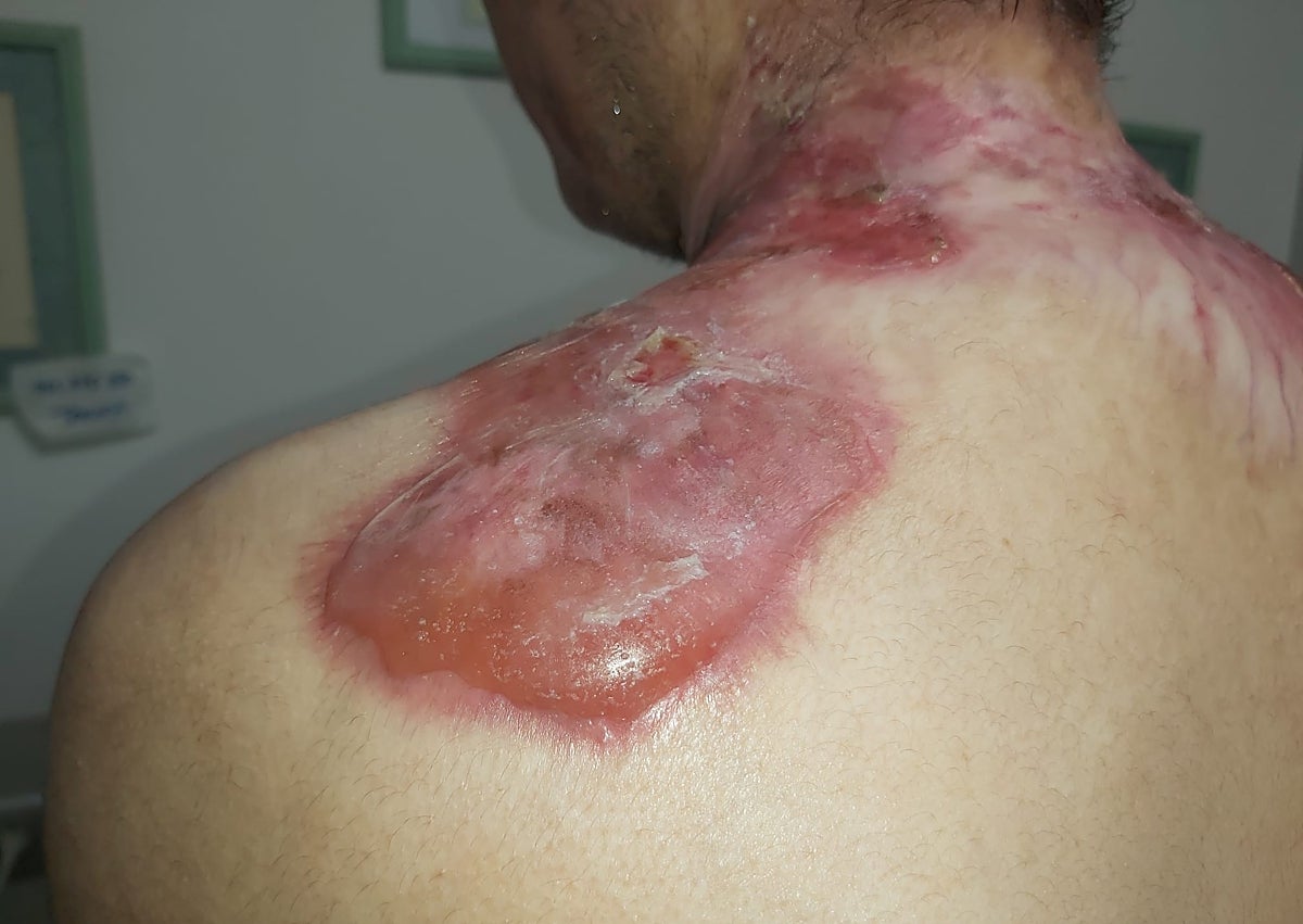 Imagen secundaria 1 - Some of the more than 80 wounds that Adrián has over his body as a result of the disease.