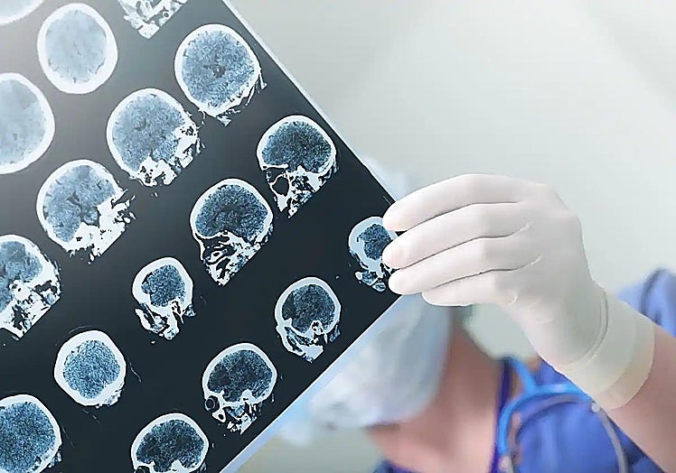 Epilepsy affects around 25,000 people in Malaga.