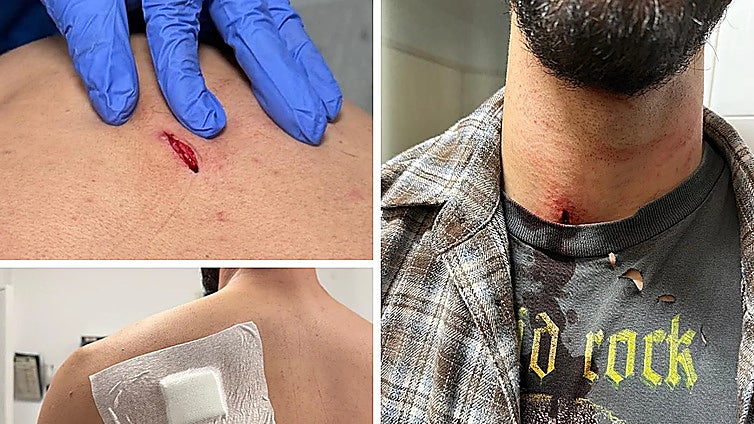 Fuengirola young man reports knife attack by two hooded individuals