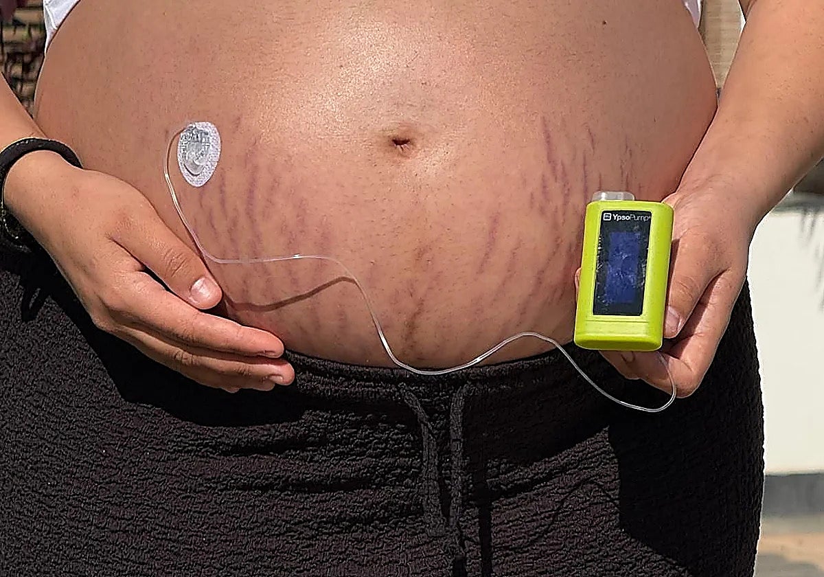 Malaga endocrinologist urges women to take measures against gestational diabetes