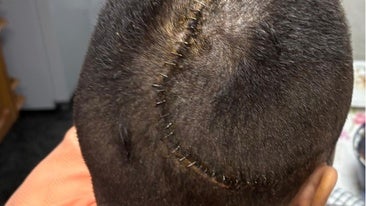 The huge gash in Juan Francisco’s head following his operation.