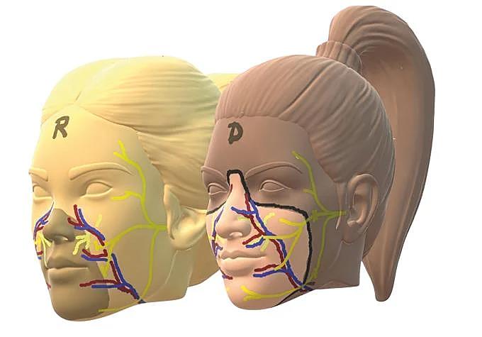 To carry out the transplant, facial tissue is removed from the donor: skin, muscles, nerves, bone and even teeth. Carmen’s upper lateral teeth, in fact, are from the donor. At the same time, the recipient is prepared by removing the damaged tissue and exposing the blood vessels and nerves that will be connected to the new face. Once blood flow has been restored, the facial nerves are reconnected.