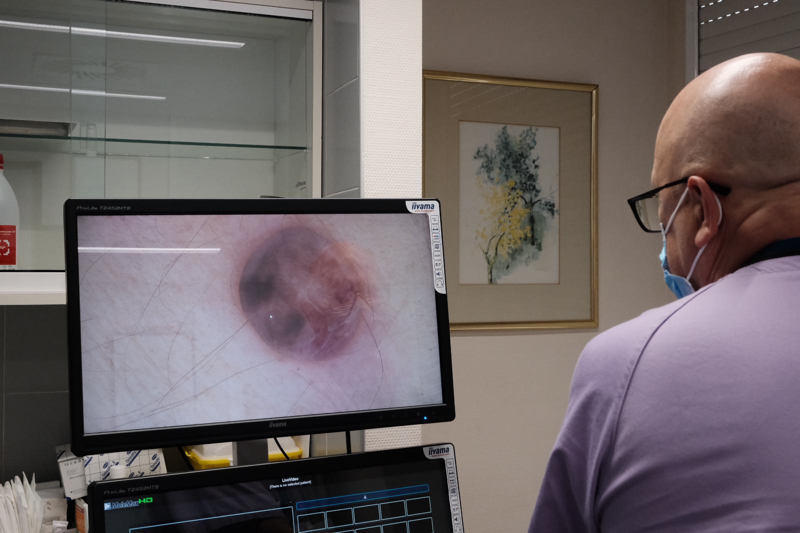 Dermatólogo observa la imagen ampliada de un lunar.