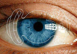 La nueva lente permite dejar de usar gafas tras la cirugía.